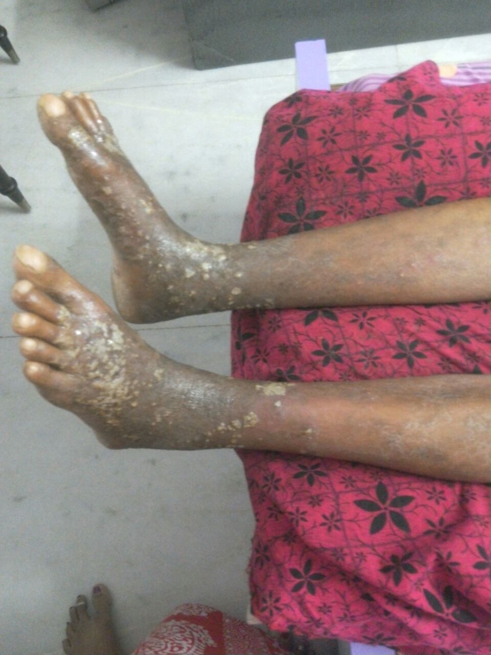 Spot The Dermatological Codition